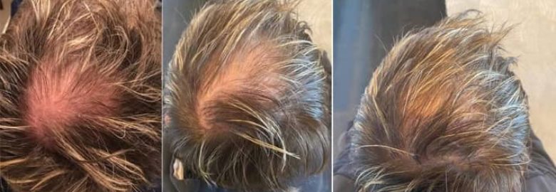 Bergen County Hair Loss