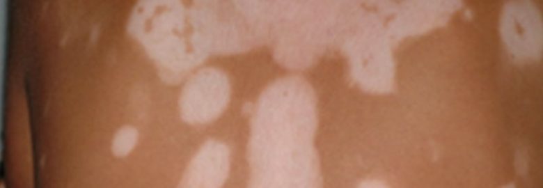 Vitiligo & Pigmentation Institute of Southern California