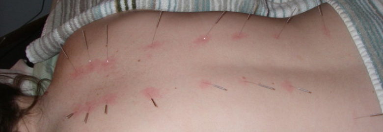 Good Needles Acupuncture and Chinese Herbal Medicine