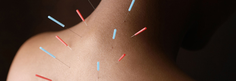 Acupuncture in Del Ray