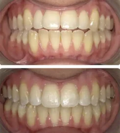 Gibbs Orthodontic Associates, P.C: Invisalign, Braces and Dentofacial Orthopedics
