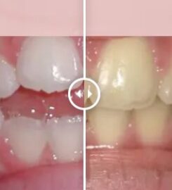 Gibbs Orthodontic Associates, P.C: Invisalign, Braces and Dentofacial Orthopedics