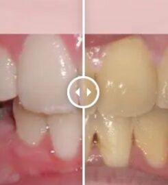 Gibbs Orthodontic Associates, P.C: Invisalign, Braces and Dentofacial Orthopedics