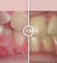 Gibbs Orthodontic Associates, P.C: Invisalign, Braces and Dentofacial Orthopedics
