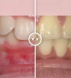 Gibbs Orthodontic Associates, P.C: Invisalign, Braces and Dentofacial Orthopedics