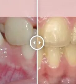 Gibbs Orthodontic Associates, P.C: Invisalign, Braces and Dentofacial Orthopedics