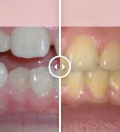 Gibbs Orthodontic Associates, P.C: Invisalign, Braces and Dentofacial Orthopedics