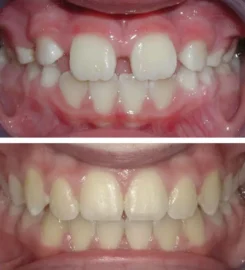 Gibbs Orthodontic Associates, P.C: Invisalign, Braces and Dentofacial Orthopedics