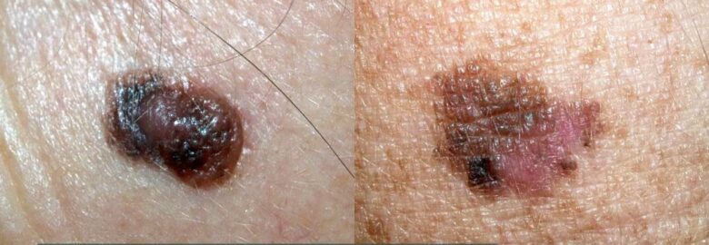 Molemap Skin Cancer Clinic